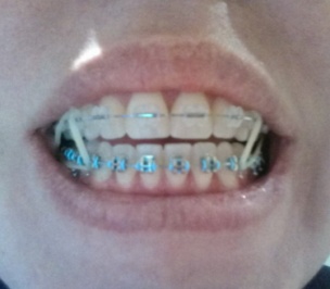 how to put rubber bands on braces
